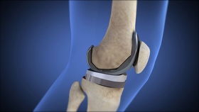 骨性關(guān)節(jié)炎 手可以感覺到磨擦感 聽到再晚需要關(guān)節(jié)置換 嚇懵